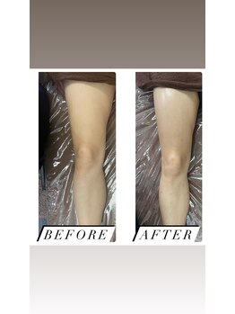 リベル(Liber)/痩身マシンエクシリス【太もも】