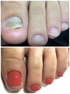 足の爪　トラブルネイル
