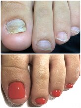 ウェルネスマルカ(wellness MARCA)/足の爪　トラブルネイル