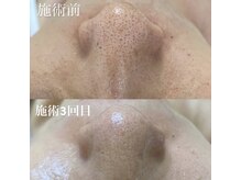 ミラージュ(Milarju)/お顔丸ごと毛穴洗浄で艶肌に♪