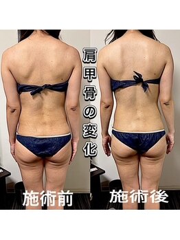 エステサロンクオーツ/肩甲骨の変化♪