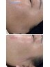 【化粧ノリUp／艶肌へ】全顔ワックス脱毛ピーリング効果＋鎮静パック男性可◎