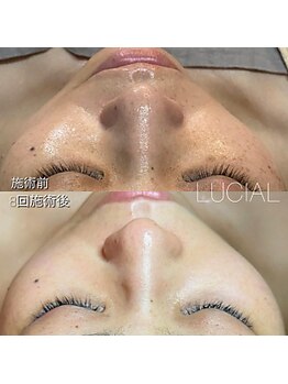 ルシアル 南浦和店(LUCIAL)/ルシアルメソッドシミケア