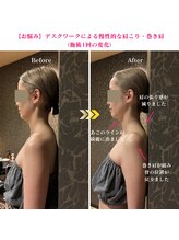 カリスタ 恵比寿駅前店/美容鍼 施術1回での変化