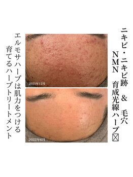 ルーナ ジェーナ(Luna llena)/なかなか改善しないニキビに