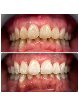 ビダンドウ(BIDANDO)/ホワイトニングビフォーアフター