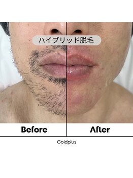 ゴールドプラス 新倉敷店(GOLD PLUS)/ヒゲWAX脱毛ビフォーアフター