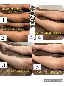 ウィチェリー(WITCHERY)/脱毛