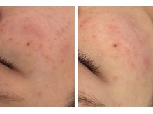 エステティック トリートメント クオリティ(Esthetic Treatments Quality)の雰囲気（弱った肌を根本から改善、肌育炭酸ガスパック改善コース）
