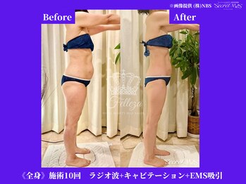 フェレザ 新潟(Felleza)/最新の痩身エステマシンです