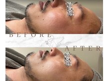 ベベ 表参道(bebe)/グランぷるぷるの男性の症例
