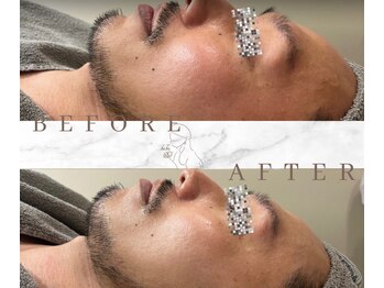 ベベ 表参道(bebe)/グランぷるぷるの男性の症例