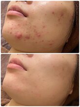 ビオプラス(BioPlus+)/ハーブピーリング/川崎