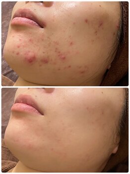 ビオプラス(BioPlus+)/ハーブピーリング/川崎