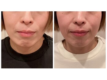 ソワン(soin)/【小顔整顔×エステ】2回効果