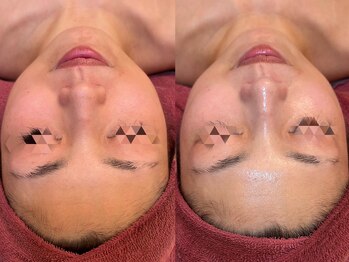 クオルーチェ(CuoLuce)/陶肌ピール(第5世代ピーリング