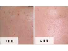 ラビエス(LAVIES)/【40代】想像以上の結果