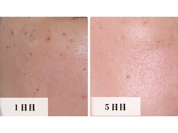 ラビエス(LAVIES)/【40代】想像以上の結果