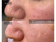 ル シーニュ/詰まり毛穴 50代