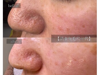 ル シーニュ/詰まり毛穴 50代