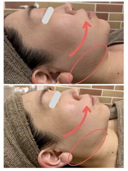 ルトゥーシア(Lotusia)の写真/顔のもたつき・輪郭にお悩みの方必見！Wラジオ波＋EMSで肌の土台からしっかりリフトアップ◎理想の小顔へ♪