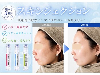 ユアーズ ビューティー(YOURS beauty)/スキンジェクション