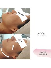 ココ センガ ビューティー クリニック(COCO SENGA Beauty-Clinic)/ジェットピールヒアルロン酸導入