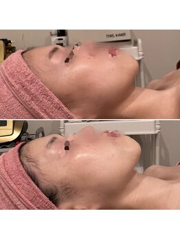 ファビリス 天王寺店(FAVILIS)/ACトリートメント1回/20代