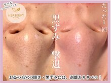 ハーバリー ハーブピーリング 大阪梅田店(HERBERRYハーブピーリング)/全国9店舗展開中★HERBERRY