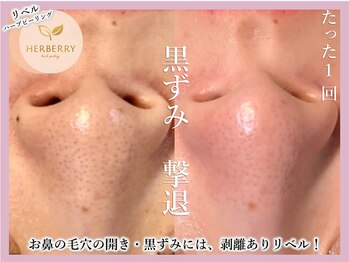 ハーバリー ハーブピーリング 大阪梅田店(HERBERRYハーブピーリング)/全国9店舗展開中★HERBERRY
