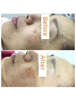 ヴィノス(VINOS)/お肌悩みはお任せ♪シミケア