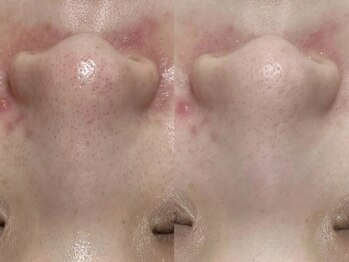 アルム(a'lm)/毛穴改善☆幹細胞×フェイシャル