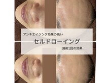 ブリリエット 天王寺店(Brilliet)の雰囲気（ルゼはエイジングケアも◎ほうれい線のシワ改善も期待できます！）