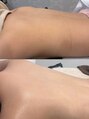 パリスヒロトン(PARIS HIROTON)&nbsp;背中ニキビ気になる方におすすめメニューございます♪♪