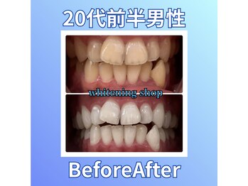 ホワイトニングショップ 西原店/20代前半男性☆BeforeAfter