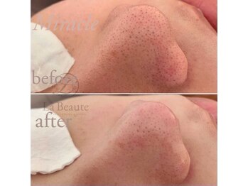 まつげアンド目元美容専門店 ミラクル(Miracle)/毛穴エクストラクションプロ