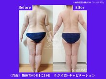 フェレザ 新潟(Felleza)/最新の美顔フェイシャルマシン♪