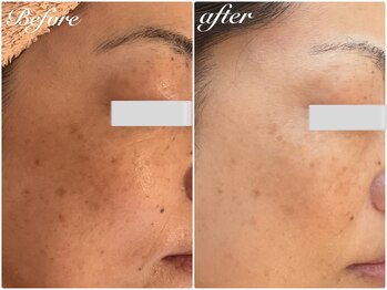 美バストアルファ(美bust α)/【シミケア】症例