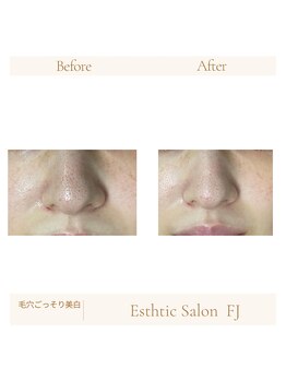 FJ/毛穴ごっそり美白