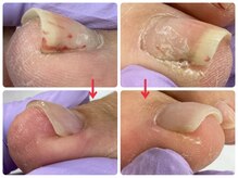 爪処 中野坂上/巻き爪ケア