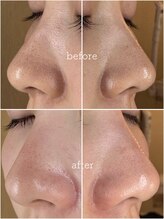 にっこりビューティー/★ハイドラフェイシャル毛穴洗浄