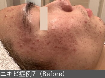 オアシスラグーン(OASIS LAGOON)/ニキビ改善(症例7 before)