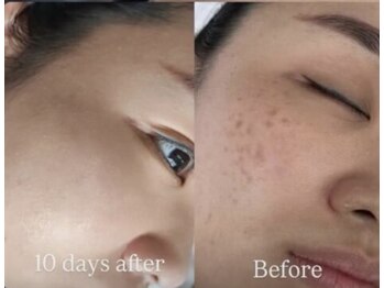 ラシュシュ(La chou chou)の写真/レーザーを使わない次世代「シミケア」ホワイトラボ導入！お肌本来の透明感を引き出し陶器肌に導きます♪