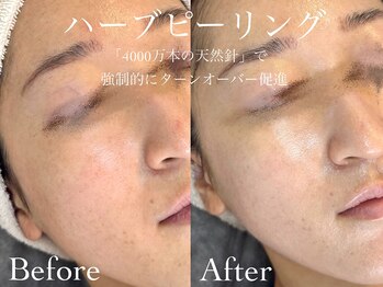 ルチーレ(Lucire)の写真/当店人気NO1★【次世代ハーブピーリング初回6,600円/2回目以降8,800円】ターンオーバーを促し韓国美肌へ