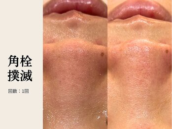 サロン ルイス アディクト(salon Lewis Addict)/毛穴洗浄
