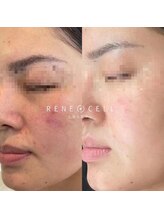 ステップイン(Step in)/ダイヤモンドピールプログラム