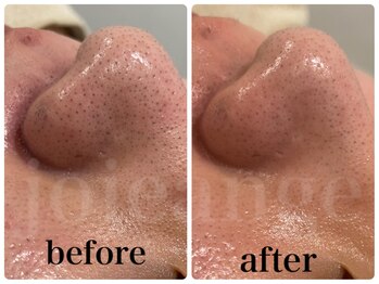 ジョアアンジェ 京橋店(joie ange)/毛穴ちゅるん！