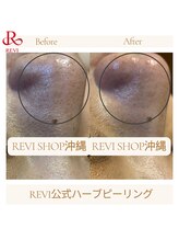 ルヴィショップ 沖縄(REVI SHOP)/予約殺到！ハーブピーリング