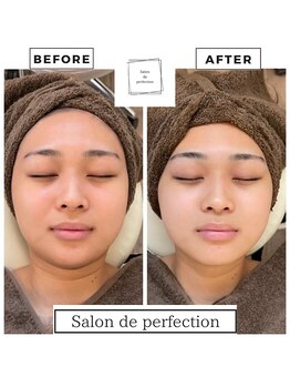 サロン ド パーフェクション(Salon de Perfection)/小顔リフト