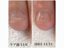 ココモ(cocomo)/噛み爪を辞めたい、、、